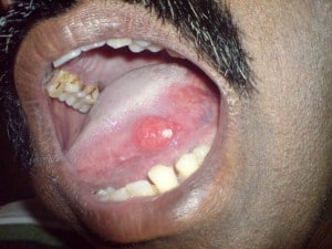 ca tongue2