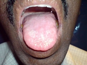 candida tongue