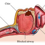cause of apnea