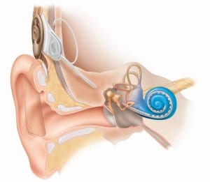 cochlear implant2