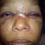 facial bone fractures facial bone fractures