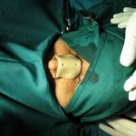 fracture nasal bone 6 fracture nasal bone 6