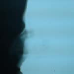 fracture nasal bone1 fracture nasal bone1