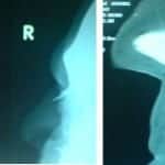 fracture nasal bone2 fracture nasal bone2