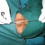 fracture nose fracture nose