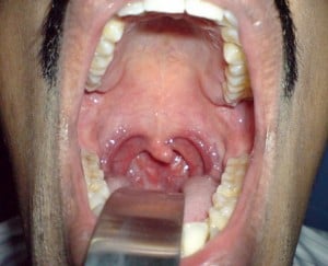 Post+tonsillectomy+infection+signs
