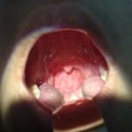 granular phryngitis