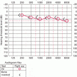 hearing loss1