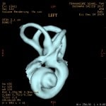 inner ear left1