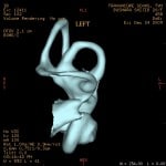 inner ear left2