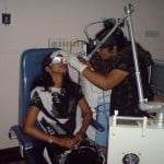 laser cautery epistaxis2