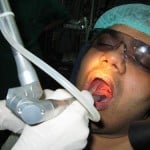 laser granular pharyngitis