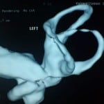 left ear obstructed s canal4