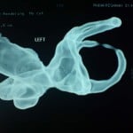left ear obstructed sc canal1