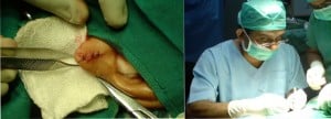 lobuloplasty picture2