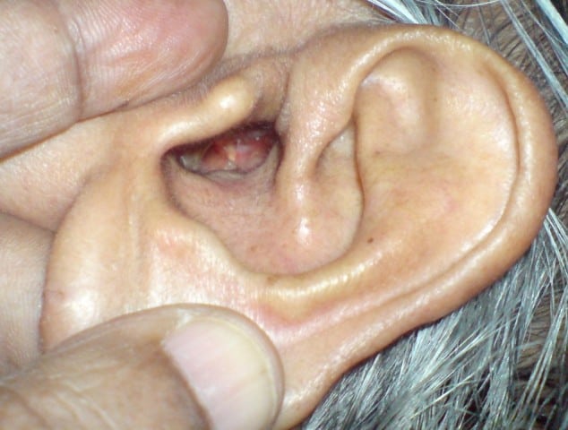 Meatoplasty Ear