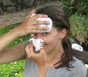 nasal bleeding