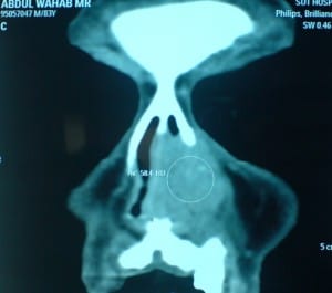 nasal tumour1