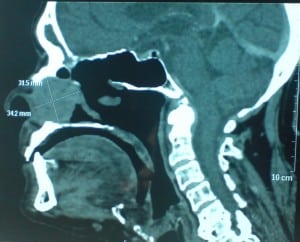 nasal tumour2