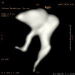 normal ossicles right ear
