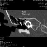 normal right ear1