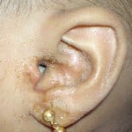 otomycosis2