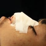 post rhinoplasty01