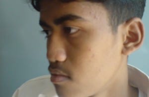 preop rhinoplastyanwar2