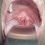residual tonsil1 residual tonsil1