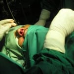 rhinoplasty17