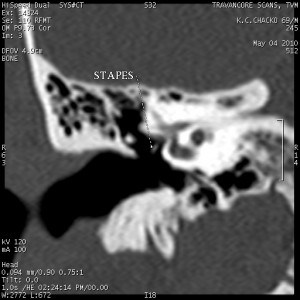 right ear otosclerosis2