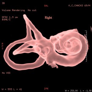 right ear otosclerosis3