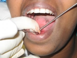 salivary gland calculi 2