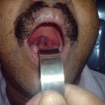 snorer blue uvula3 snorer blue uvula3