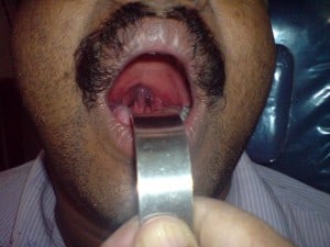 snorer blue uvula3