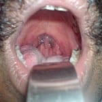 snrorer blue uvula2 snrorer blue uvula2