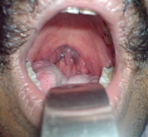 snrorer blue uvula2