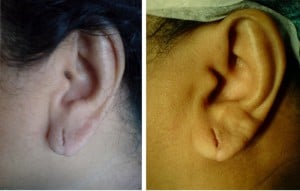 split ear lobe001