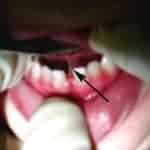tongue tie