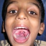 tonsil2 tonsil2
