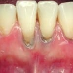 tooth decay
